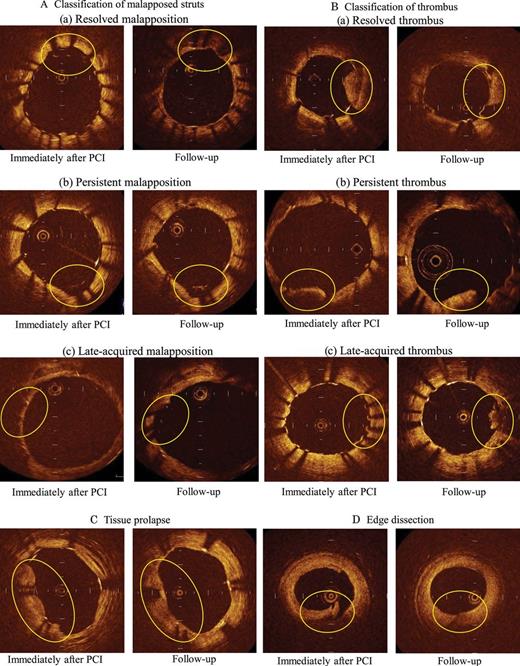 Representative OCT images: (A) classification of malapposed struts: (a) resolved malapposition, (b) persistent malapposition, (c) late-acquired malapposition, (B) classification of thrombus: (a) resolved thrombus, (b) persistent thrombus, (c) late-acquired thrombus, (C) tissue prolapse, (D) edge dissection.