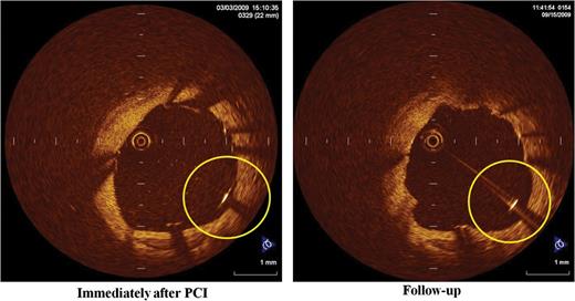 A case of persistent malapposed struts with a baseline S–V distance ≤260 μm: left panel shows the OCT image immediately after Taxus Liberte™ implantation. The S–V distance is 180 μm, which is less than the cut-off value of the S–V distance of 260 μm. These malapposed struts persisted on follow-up OCT images (right panel), probably due to plaque regression or thrombus dissolution.
