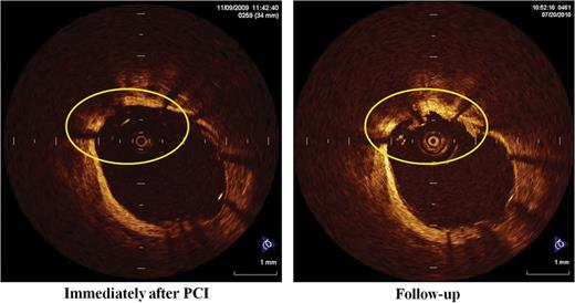 A representative case of thrombus with late stent malapposition.