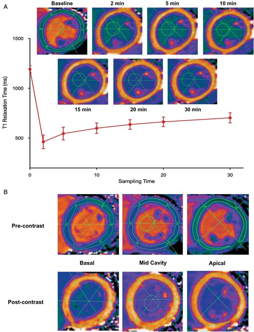 Methodology for measuring myocardial T1 at multiple time points and in multiple segments of the left ventricle (A) Measurement of myocardial T1 at multiple time points. ROI were drawn within the borders on the pre-contrast myocardial T1 maps and then copied onto the corresponding post-contrast images at all time points. Minor adjustments were made to avoid artefact and blood pool. An ROI was also drawn in the left ventricular blood pool in order to calculate the partition coefficient (λ) and extracellular volume fraction (ECV) at each time point. This approach demonstrated excellent intra- and inter-observer reproducibility. (B) Assessment of regional variation in T1 measures. Using the anterior and inferior ventricular insertion points as well as the mid-point of the ventricular cavity as reference points, three intersecting lines were drawn to divide the left ventricle into 16 segments. ROI were drawn onto the basal (six segments), mid-cavity (six segments), and apical (four segments) pre-contrast T1 maps with the standardized approach described above. Subsequently, the ROI were copied onto the 20-min post-contrast T1 maps. Pre- and post-contrast T1, λ, and ECV values were assessed in each segment