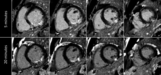 Overestimation of infarct size in a patient with non-transmural infarction. In a patient with a non-transmural infarction in the right coronary artery territory, the enhancement at 5 min (upper row) is clearly greater than at 20 min (lower row) after contrast administration.