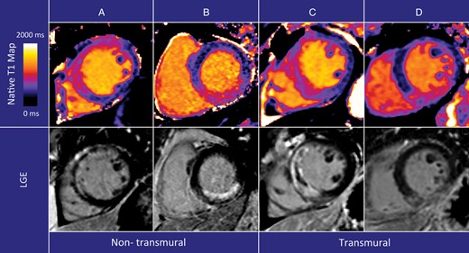 Native T1 maps in non-transmural and transmural infarction. Native T1 maps (top row) and LGE of the infarction (bottom row). Both in patients with non-transmural and transmural infarctions, the abnormality in native T1 abnormality appears transmural. The culprit lesion was the left anterior descending artery in images in (A and C) and the right coronary artery in (B and D).