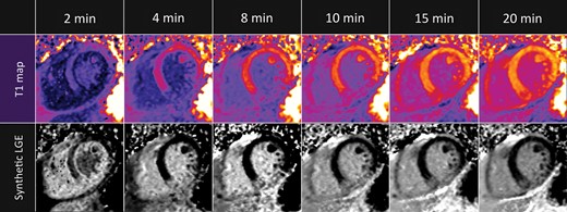 T1 maps and synthetic LGE in a patient with transmural infarction. The extent of LGE is constant throughout the entire imaging period. T1 maps (upper row) and synthetic LGE images (bottom row).