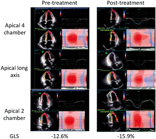 Longitudinal systolic strain by speckle tracking in a typical patient with cardiac amyloidosis prior to and following chemotherapy is illustrated in the apical four-chamber (upper panel), apical long-axis (middle panel), and apical two-chamber (lower panel) views. Note the separation of strain curves with higher (more negative) strain in the apical vs. basal segments as well as the prominent red color indicating higher (more negative) strains in the apical segments on the 2D, and reconstruction maps.