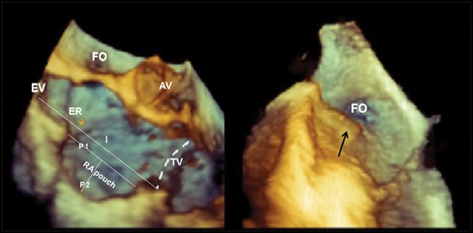 Three-dimensional transesophageal echocardiography (3D-TEE) image of the cavo-tricuspid isthmus (CTI). The CTI is delimited anteriorly by the atrio-ventricular right atrial (RA) groove (dashed line). Main CTI anatomic constituents and the qualitative and quantitative evaluations considered are presented and include Eustachian valve (EV), Eustachian ridge (ER), pectinate muscle (black arrow right panel), isthmus tele-diastolic and tele-systolic lengths (I), and RA pouch tele-diastolic and tele-systolic lengths (P1) and depths (P2). RA Pouch is considered a profound depression of the central CTI (left panel). The right panel focuses on a very prominent muscular irregularity, pectinate muscle (black arrow), usually observed at the level of the infero-lateral CTI. AV, aortic valve; FO, foramen ovale; TV, tricuspid annulus.