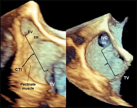 These two 3D TEE images depict structural and morphological heterogeneity of the CTI. Left panel: anatomically complex CTI presenting all features requiring longer ablation time to achieve bidirectional block. Right panel: regular flat-shaped CTI without the presence of depressions; there are only modest surface irregularities determined by pectinate muscles which represent the continuation of muscular ramifications from the crista terminalis. IVS os, inferior vena cava ostium; ER, Eustachian ridge; EV, Eustachian valve; TV, tricuspid valve.