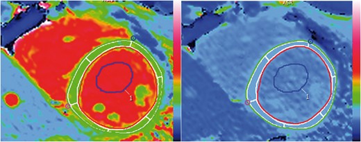 Example of myocardial and blood ROIs in ShMOLLI native (left) and post-contrast (right) T1 maps. Manual epicardial (green) and endocardial (red) contours with 10% erosion offset (white borders) drawn in the native ShMOLLI T1 map (left) and exported on to the post-contrast map (right) are shown. The myocardial ROI is segmented according to the AHA model. A blood ROI was also drawn in the native T1 map and copied on to the post-contrast map.