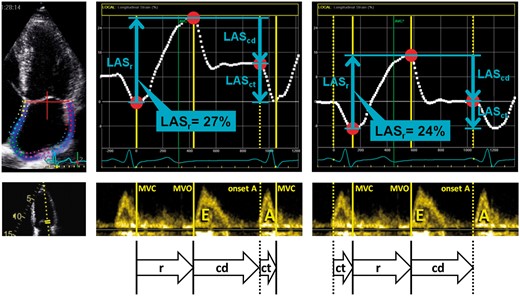 Measurement of left atrial strain components. Left panel: with the zero strain reference at end-diastole (recommended), right panel: with zero strain reference at the onset of atrial contraction. In both cases, three measurement points (red dots) are needed to calculate the deformation during the three phases of the LA cycle: r, reservoir phase; cd, conduit phase; ct, contraction phase. The respective strains are LASr, calculated as difference between onset of filling and end-diastole; LAScd, calculated as difference between onset of atrial contraction and onset of filling; LASct, calculated as difference between end-diastole and onset of atrial filling. Note that the entire strain curve changes its amplitude depending on the definition of the zero reference. MVO, mitral valve opening; MVC, mitral valve closure; E, A, E- and A-wave of the mitral inflow.