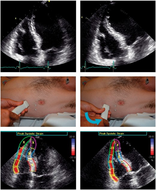 Correct image orientation of the conventional (upper left panel) and right ventricular (upper right panel) apical four-chamber views. Probe positions to acquire the conventional apical four-chamber view (mid-left panel) and the right ventricular focused apical four-chamber view (mid-right panel). Differences in right ventricular free wall longitudinal strain between the conventional (lower left panel) and the right ventricular focused (lower right panel) four-chamber apical views. Note that, using the conventional four-chamber view, the right ventricular apex cannot be tracked (out of the scan sector), whereas it is easily tracked by using the right ventricular focused view.