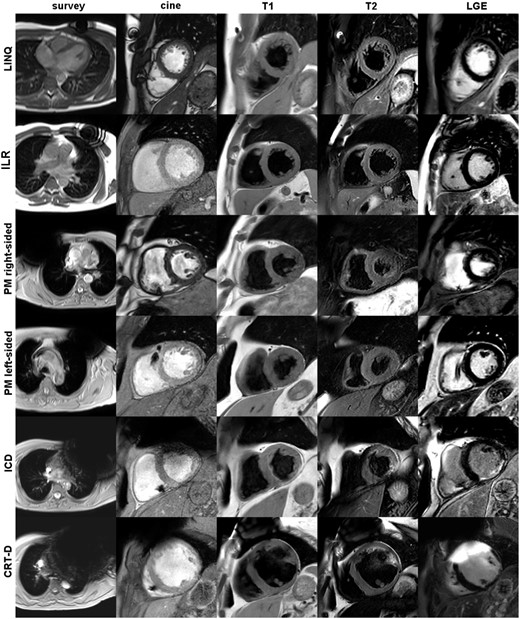 Overview of image quality according to device types and CMR imaging sequences. Columns from left to right: survey scan, transversal slice of the initial scout images showing the maximum extent of the generator-related artefact; cine, short-axis scan geometry using cine SSFP imaging in case of a LINQ or right-sided PM and post-contrast cine SGE imaging in case of an ILR, a left-sided PM, an ICD or a CRT-D; in addition, T1-, T2-weighted, and LGE images are shown in short-axis geometry.