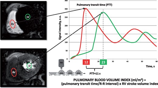 Pulmonary transit time and PBVI. SI/time curves of two regions of interest drawn in the RV cavity (red) and in the LV cavity (green), respectively. PTT is defined by the time interval between the peaks of the two SI/time curves. PBVI is obtained by the product between the RVSVI and the pulmonary transit time normalized by the R-R interval (see Methods section). Gd, gadolinium; LV, left ventricle; PBVI, pulmonary blood volume index; PTT, pulmonary transit time; RV, right ventricle; RVSVI, right ventricular stroke volume index; SI, signal intensity.