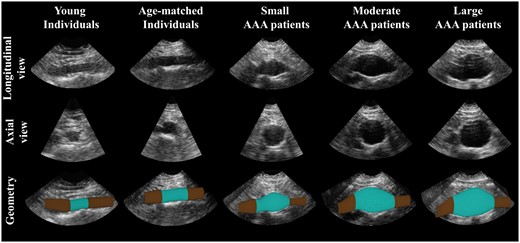 Examples of a longitudinal and cross-sectional view of the 3D ultrasound data for a young, and age-matched individual, and a small, moderate, and large AAA patient (from left to right). At the bottom row the segmented geometry is shown (blue) with the elongation needed for correct wall stress analysis (brown).