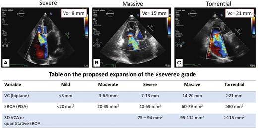 New classification scheme of significant TR. New classification scheme determined by 2D biplane echocardiographic assessment of vena contracta regurgitant volume. Upper panel: vena contracta measurements of (A) severe; (B) massive; (C) torrential TR. Lower panel: table on the proposed expansion of the ‘severe’ grade by Hahn and Zamorano. 3D VCA, three-dimensional vena contracta area; EROA, effective regurgitant orifice area; VC, vena cava. Reproduced with permission from Ref.7