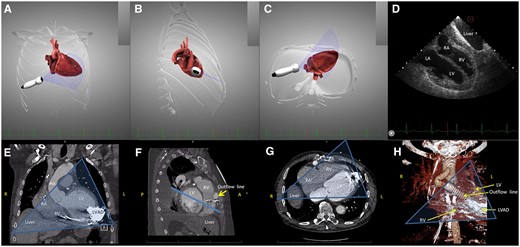 The right intercostal transhepatic imaging plane, demonstrated on the simulator (HeartWorks v2.0.60.0, Inventive Medical Ltd, MedaPhor Group plc 2019, UK) and on computed tomography on one LVAD patient. (A–C) Computer simulated direction of the probe and imaging plane in order to obtain a four-chamber view: (A) frontal plane; (B) right lateral view; (C) inferior view; (D) the computer simulated echocardiography demonstrating a modified four-chamber view, the liver is also in the imaging plane; (E) computed tomography angiogram (CTA) of an LVAD patient, the transhepatic echocardiography imaging plane is drawn over the image as a transparent triangle in the frontal (A, anterior) plane; and (F) side view of CTA images demonstrating the interposition of the outflow line between the heart and the chest wall. The echocardiography imaging plane, drawn over the image as a line, is situated posterior to the outflow LVAD line, and intersects only the heart cavities; (G) inferior view of the same patient, the transhepatic echocardiography imaging plane is drawn over the image as a transparent triangle. The LVAD is situated in the far field; and (H) 3D reconstruction from CTA images of the same LVAD patient, in the frontal (A, anterior) plane. Bone structures have been excluded, in order to allow visualization of the outflow line, situated between the heart and the chest wall. The echocardiography imaging plane, drawn over the image as a transparent triangle, is situated posterior to the outflow LVAD line. LA, left atrium; LV, left ventricle; LVAD, Left ventricle assist device; RA, right atrium; RV, right ventricle.