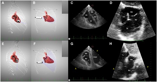 The transhepatic four-chamber view (A–D) and right ventricular view (E–H). (A and B) imaging plane and probe position demonstrated on the simulator; (C) virtual transhepatic echocardiography, four-chamber view; (D) real transhepatic echocardiography, the same incidence on a LVAD patient; (E and F) clockwise rotation of the probe and anterior tilting to obtain the right ventricular view; (G) virtual transhepatic echocardiography, right ventricular view; and (H) real transhepatic echocardiography, the right ventricular view on an LVAD patient.