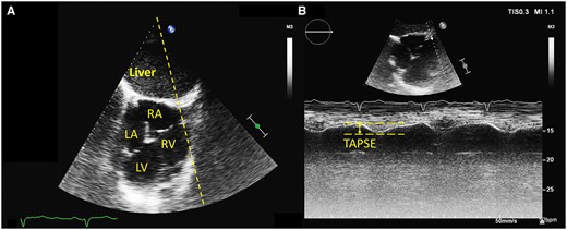Right ventricular function assessed in transhepatic view by tricuspid annular plane systolic excursion (TAPSE). (A) general transhepatic view of an ‘inverted’ four-chamber view. The TAPSE M-mode line is drawn over the image (dotted line). (B) TAPSE measurement from the transhepatic view. The systolic excursion is also inverted (downward movement in systole).