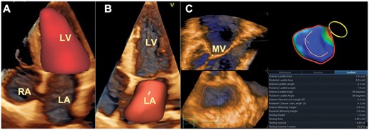 Use of 3D echocardiography to assess the pathophysiology of functional mitral regurgitation. (A) Surface rendering of the left ventricle to obtain volumes, shape, ejection fraction, and total stroke volume. (B) Surface rendering to obtain phasic volumes and function of the left atrium. (C) Surface rendering of the mitral valve to obtain quantitative assessment of the mitral annulus geometry and leaflet size. LA, left atrium; LV, left ventricle; MV, mitral valve; RA, right atrium.