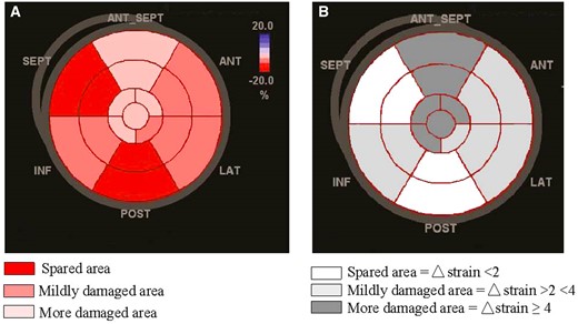 Pattern of anthracyclines mediated regional myocardial damage by speckle-tracking echocardiography shown in A by mean values of longitudinal strain (%) and in B by delta strain (%). Apex and anterior septum (pink segments in A; dark-grey segments in B) show the greater impairment.
