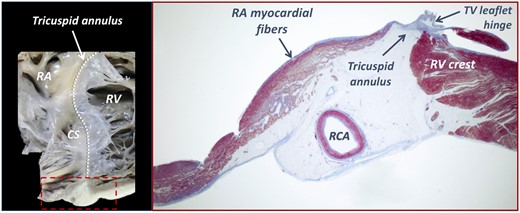The anatomy of the right atrio-ventricular junction. Note the adipose structure of the atrioventricular groove, including the RCA and veins, and the close spatial relationship between the subendocardial muscular fibres and the fibrous leaflet hinge at the tricuspid annulus level (dashed line). CS, coronary sinus.