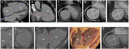CT-assessment of the tricuspid annulus. (A–E) Manual approach: from a four- (A) and two-chamber views (B), a short-axis view of the tricuspid annulus is reconstructed (C). 2D-derived parameters in end-diastole (D) and mid-systole (E). (F–J) Semi-automated software-based approach: (F and G) After automated segmentation, the annulus is traced by selecting the hinge points (white dots). 2D- (H) and 3D-annular view (I). (J) Apical view of the annular plane in end-diastole: the commissures (anteroseptal, SA, pink; AP, blue; posteroseptal, SP; green) are depicted. Annular parameters are automatically calculated. AP, anteroposterior; RA, right atrium; RV, right ventricle; SL, septolateral.