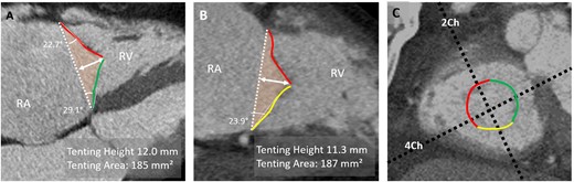 CT-assessment of leaflet tethering. (A) In a reconstructed RV four-chamber view, tenting height is measured as the distance between annular plane (dashed white line) and coaptation point between the anterior (red) and septal (green) leaflets. Tenting angle and area (orange-coloured area) can also be obtained in this view. (B) In a reconstructed two-chamber view, tenting angle for the posterior leaflet (yellow) and area is assessed. (C) Short-axis view of annulus. 4Ch, four-chamber plane; 2Ch, two-chamber plane; RA, right atrium.