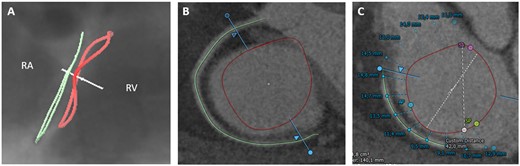 Tricuspid annulus in relation to the right coronary artery. CT-derived fluoroscopic (A) and short-axis view (B) of the tricuspid annulus (red line) and the RCA (green line) demonstrating a superior (atrial) course of the vessel in relation to the annulus. (C) Semi-automated assessment of distance from the tricuspid annulus to the RCA. RA, right atrium; RV, right ventricle.