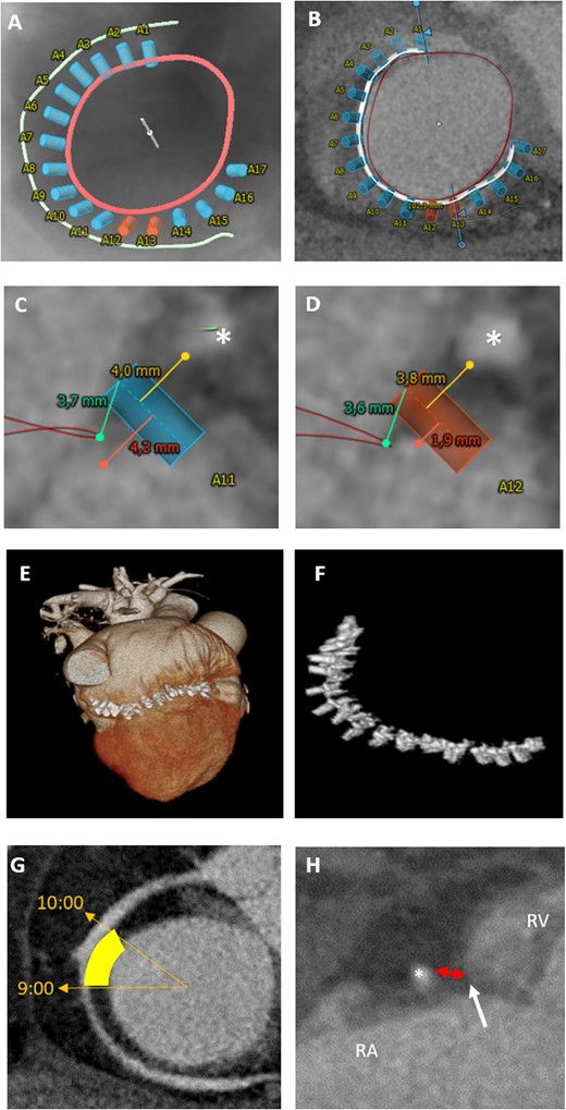 CT-assessment for annuloplasty intervention. (A–F) Cardioband: CT-derived fluoroscopic (A) and short-axis view (B) of the tricuspid annulus (red) with simulation of anchored device (white line with blue and orange anchors) in relation to the RCA (green). Blue anchors have a distance of at least 4 mm to the RCA (asterisk) (C), whereas orange anchors with a distance of <4 mm indicate a higher risk for RCA impairment (D). (E, F) Postprocedural 3D volume rendering data set with implanted cardioband device. (G, H) TriCinch device: (G) short-axis view of the tricuspid annulus, yellow area highlights the target zone for coil implantation (at 9:00 to 10:00). (H) Assessment of pericardial space distance (red double arrow) between RCA and annulus (white arrow) for coil implantation. RA, right atrium; RV, right ventricle.
