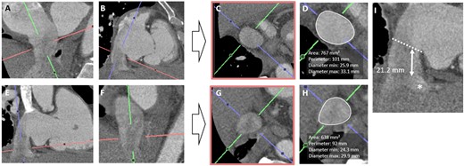CT-assessment for heterotopic valve implantation. Assessment of IVC dimensions (perimeter, area, and diameters) in a double oblique transverse plane at the transition level with the right atrium (A–D) and at the level of the first hepatic vein (D–F). Measurement of the distance between the junction plane of the IVC and right atrium (dashed line) and first hepatic vein (asterisk) to ensure optimal valve positioning without hepatic vein obstruction.