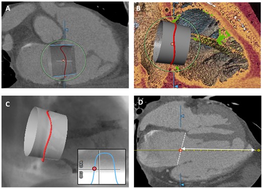 CT-assessment for orthotopic tricuspid valve implantation. (A) Virtual prosthesis implantation in the tricuspid annulus (right) for assessment of implantation depth, valve selection, and anchoring possibilities. (B) 3D-view visualizes possible interference of the device with trabeculae (green). (C) CT-derived simulated view for prediction of an optimal fluoroscopic projection angle. (D) Measurement of distance between annular plane (white-dashed line) and apex.