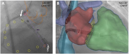 Fusion imaging for tricuspid valve interventions. (A) Annuloplasty: placement of first Cardioband anchor (arrow) supported by CT/fluoroscopy fusion imaging. Pink ring: right coronary artery ostium; orange outline: aortic root and ascending aorta; yellow rings: planned anchor placement. (B) Valve replacement: CT images of right atrium (red), right ventricle (green), caval veins (blue), and pulmonary veins (purple) are integrated into the live fluoroscopic views to support device positioning.