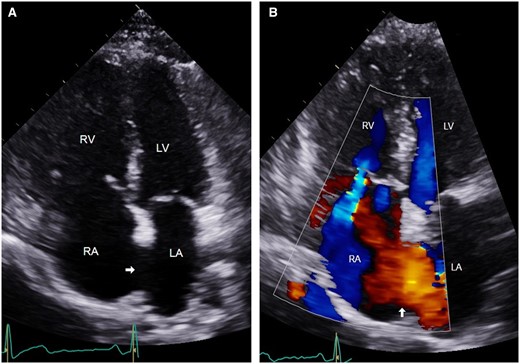 (A) Apical four-chamber view of transthoracic echocardiogram showing large secundum ASD (arrow). (B) Colour Doppler showing left to right shunt across the ASD (arrow). LA, left atrium; LV, left ventricle; RA, right atrium; RV, right ventricle.