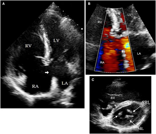 (A) Transthoracic echocardiogram of apical four chamber view showing a primum ASD (arrow). (B) Focus view of atrioventricular junction colour Doppler showing left-to-right shunt across primum ASD (arrow). (C) Short-axis view of same patient showing the tri-leaflet left AV valve. IBL, inferior bridging leaflet; LA, left atrium; LV, left ventricle; ML, mural leaflet; RA, right atrium; RV, right ventricle; SBL, superior bridging leaflet.