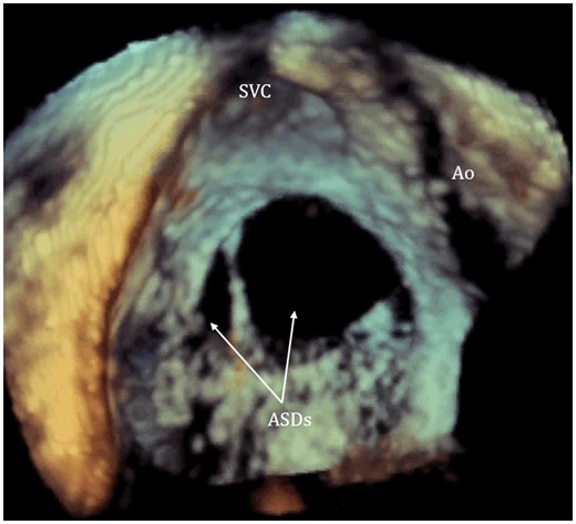 The 3D visualization of intra-atrial septum from right atrium using transoesophageal echocardiogram demonstrating two separate secundum ASDs with irregular shape (arrow pointed). ASDs, atrial septal defects; Ao, aorta; SVC, superior vena cava.