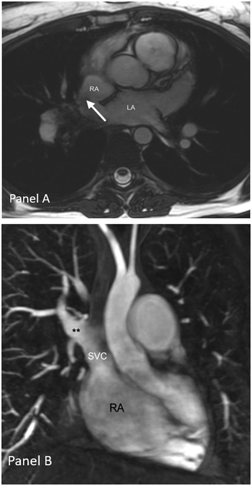 (A) Atrial septal defect of sinus venosus type visualized on axial CMR cine images and (B) CMR of partial anomalous pulmonary venous connection of the right upper pulmonary vein**. LA, left atrium; RA, right atrium; SVC, superior vena cava.