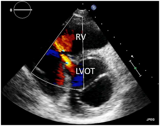 Transthoracic echocardiogram of perimembranous ventricular septal defect, parasternal short-axis view. LVOT, left ventricular outflow tract; RV, right ventricle.