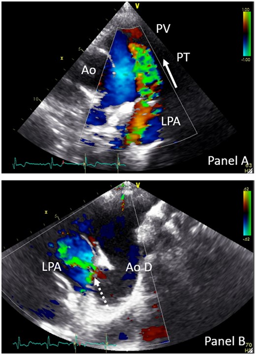 TTE parasternal short-axis colour Doppler view (A) and suprasternal colour Doppler view of PDA (B). Dotted arrow indicates PDA; full arrow indicates flow direction of the systolic and diastolic colour flow. Ao, aorta; Ao D, aorta descendens; LPA, left pulmonary artery; PT, pulmonary trunk; PV, pulmonary valve.