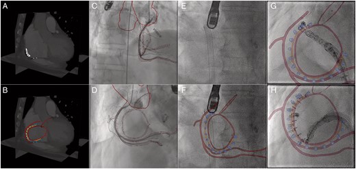 Prior to the intervention, the planning details (RCA, valve annulus, CS ostium, aortic root circle, trajectory) are marked in the pre-procedural CT (A). Subsequently, the planning details and required anatomical structures (e.g. aorta) are segmented (B). For better visibility of the trajectory, only the anchors of the Cardioband are segmented. Coregistration between XR and CT is obtained at the beginning of the procedure, based on RCA angiograms acquired in right anterior oblique (C) and surgical ‘en face’ orientation (D). In contrast to live XR fluoroscopy without augmentation (E), live XR fluoroscopy with augmentation is now provided throughout the procedure. Image fusion at different stages of the anchor implantation are shown in F (beginning), G (initial stage), and H (intermediate stage). Further interaction steps are limited to manual refinement of the registration during the procedure if required. Colour-coded overlay: anatomic landmarks (red), planned anchor positions (blue), trajectory (orange).