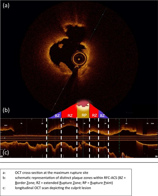 Representative OCT-case with schematic illustration of the plaque zones within RFC-ACS. (A) OCT cross-section at the maximum rupture site. (B) Schematic representation of distinct plaque zones within RFC-ACS. (C) Longitudinal OCT scan depicting the culprit lesion. BZ, border zone; OCT, optical coherence tomography; RZ, extended rupture zone; RP, rupture point; RFC-ACS, ruptured-fibrous cap acute coronary syndrome.