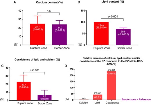 Differences among the extended rupture and border zone within ruptured fibrous cap ACS-causing culprit lesions (n = 204). ACS, acute coronary syndrome. Figure 2A, 2B and 2C: Show the percentage of individual plaque components (Figure 2A: Calcified components (CC), Figure 2B: Lipid components (LC), Figure 2C: Coexisting components (LCC) within Rupture and Border Zone). Figure 2D: Displays the relative increase of each component at the Rupture zone as compared to the Border Zone.