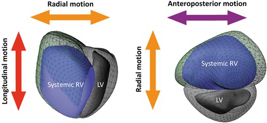 Three-dimensional schematic representation of the three major components contributing to total pump function of the systemic RV: (i) longitudinal shortening along the long-axis (red) contributing to RV longitudinal ejection fraction component, (ii) inward (radial) motion of the RV free wall (orange) contributing to radial ejection fraction component, and (iii) short-axis shortening in the anteroposterior direction in parallel with the septum (purple) contributing to antero-posterior ejection fraction component. Green mesh represents systemic RV end-diastolic volume, the blue surface—the systemic RV end-systolic volume. LV, left ventricle; RV, right ventricle.