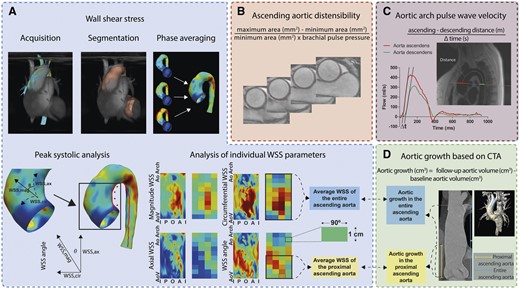 Data analysis overview of the WSS, pulse wave velocity, aortic distensibility, and aortic growth. (A) Peak systolic 4D flow CMR based aortic WSS of the ascending aorta was analysed separately as WSSmagnitude and its components WSSaxial and WSScircumferential. WSS angle is the angle between the WSSmagnitude and WSSaxial. The 2D WSS maps are cut open (over the red line, inner curvature) 3D WSS maps. The WSS measured directly after the aortic valve is indicated with aortic valve (AoV), while the WSS distal in the ascending aorta is indicated as aortic arch (Ao Arch). On the left and right border are WSSs measured at the inner curvature (I), whereas in the centre of the map are WSSs measured at the outer curvature (O). WSSs were averaged per region. Regions are indicated as one box. (B) Aortic distensibility measurement also at the level of the pulmonary artery. (C) 2D flow-based pulse wave velocity measurement at the level of the pulmonary artery. (D) CTA-based aortic growth from the aortic valve up to first 5 cm (proximal ascending aorta) and the distal edge of the innominate artery (entire ascending aorta). A, anterior; CMR, cardiovascular magnetic resonance; CTA, computed tomography angiography; I, inner curvature; O, outer curvature; P, posterior; WSS, wall shear stress.