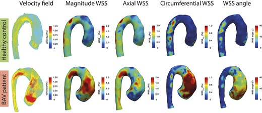 Representative example of peak systolic velocity fields, WSSmagnitude, WSSaxial, WSScircumferential, and WSS angle maps in a patient with BAV with left–right fusion and a healthy control. Streamlines in the BAV-LR patient show an eccentric flow jet in the ascending aorta, which is absent in the healthy control. Very high velocities in the circumferential direction can be observed in the BAV-LR patient, which is reflected by the strikingly higher WSScircumferential levels and large WSS angles compared with the healthy control in the region corresponding to the region impacted by the eccentric flow jet in the ascending aorta. Average WSScircumferential and WSS angle were 0.8 Pa and 55° for the BAV-LR patient and 0.3 Pa and 20° for the healthy control, respectively. BAV, bicuspid aortic valve; BAV-LR, bicuspid aortic valve with left-right fusion pattern; WSS, wall shear stress.
