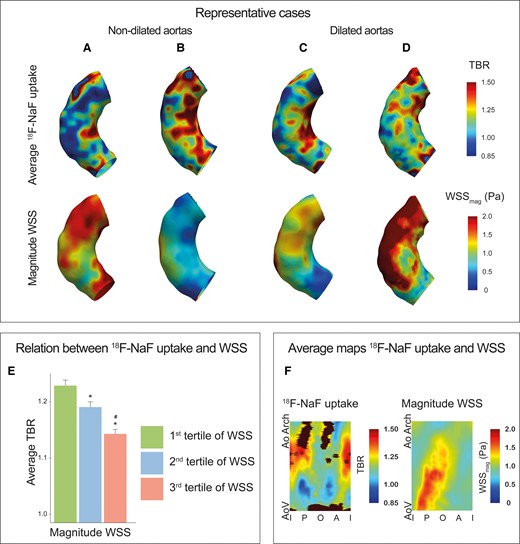 Inverse relationship between 18F-NaF activity and magnitude WSS in the ascending aorta of patients with bicuspid aortic valve disease. (A–D) Representative cases demonstrating increased 18F-NaF activity and lower magnitude WSS on the inner curve of the ascending aorta in patients with BAV with and without aortic aneurysms. (E) Bar graph demonstrating decreasing aortic 18F-NaF activity across magnitude WSS tertiles; *P < 0.05 vs. first tertile; #P < 0.05 vs. second tertile. (F) An average 18F-NaF uptake and WSS map calculated from all the BAV patients, again showing an inverse relationship between 18F-NaF uptake (left) and magnitude WSS (right) measurements made within 1.4 ± 0.6 cm2 regions of interest. A, anterior; AoArch, aortic arch; AoV, aortic valve; BAV, bicuspid aortic valve; I, inner; O, outer; P, posterior; WSS, wall shear stress.
