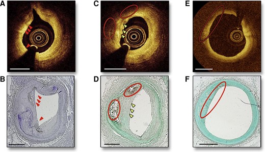 Intravascular coronary OCT demonstrating macrophages visible as bright spots (A, arrows) with CD68 stain confirmation (B). Macrophages are also visualized as bright spots and dark regions (C, arrows and circles, respectively) with histological confirmation of macrophages by CD68 staining (D). A region far from the OCT catheter is depicted in (E) without evidence of bright spots, but with CD68 stain confirmation of macrophages in (F) likely reflecting loss of information at greater distances from the catheter. Adapted with permission from Phipps et al.53