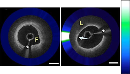 Combined intravascular coronary OCT with NIRAF demonstrates a fibrotic plaque with low NIRAF signal (A) and a fibroatheroma with high NIRAF signal corresponding to dense macrophage accumulation (B). Adapted with permission from Ughi et al.84 The asterisk (*) corresponds with catheter artefact. F, fibrotic; L, lipid.
