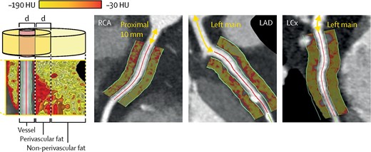 Perivascular fat attenuation analysis of the proximal epicardial coronary vessels as defined by fat within a radial distance of the diameter (d) of the vessel. Adapted with permission from Oikonomou et al.87 HU, Hounsfield units; RCA, right coronary artery; LAD, left anterior descending artery; LCx, left circumflex artery.