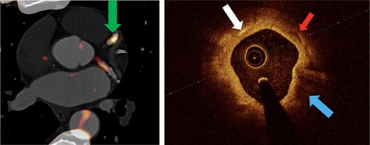 OCT features of high-risk atherosclerotic plaque associated with 18F-NaF PET uptake. The region of increased 18F-NaF activity in the left anterior descending artery (left), green arrow, is imaged with OCT (right). This region has multiple high-risk plaque features on OCT. Adapted with permission from Bellinge et al.103 White arrow indicates cholesterol crystals; red arrow indicates microcalcifications; blue arrow indicates lipid-rich plaque.