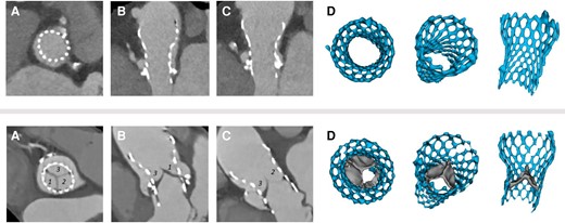 Representative CTA images of an aortic prosthesis without (upper panel) and with (lower panel) HALT. End diastolic, short axis (A), multiplanar (B and C), and 3D (D) reconstructions. Upper panel: the cusps of the prosthesis are basically nonvisible, representing normal prosthesis morphology without leaflet thickening. The summed leaflet score is 0 point. Lower panel: Cusps 1 and 3 have moderate leaflet thickening (2–2 points), Cusp 2 has mild leaflet thickening affecting the margin of the leaflet (one point). The summed leaflet score is five points. CTA, computed tomography angiography; HALT, hypoattenuated leaflet thickening; TAVI, transcatheter aortic valve implantation.