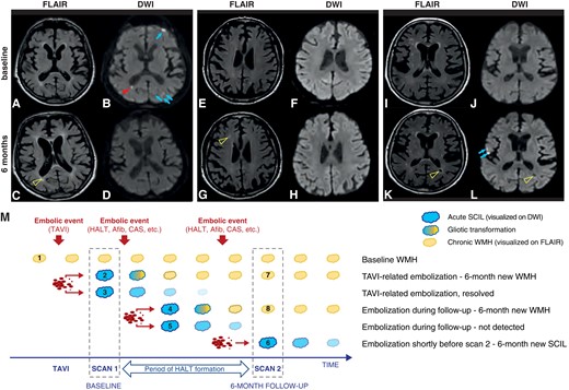 (A–L) Brain MRI images representing the various lesions analysed. (A–D) Procedural SCILs in multiple territories on DWI (B), which disappeared during follow-up without leaving permanent cerebral lesions (arrows), and one small periventricular SCIL (arrowhead) that evolved into gliotic scar on the 6-month MRI FLAIR image (C, open arrowhead). (E–H) New WMH on the 6-month MRI FLAIR image (G, open arrowhead), without restricted diffusion on DWI (H) that was not present at baseline on the FLAIR (E) or DWI images (F). (I–L) New lesions on the 6-month MRI that were not present at baseline. (K and L) 6-month new SCILs (L, arrows) that were not present at baseline (J); 6-month new chronic ischaemic lesion (WMH) on the FLAIR image (K, open arrowhead) with central signal intensity similar to fluid on DWI (L, open arrowhead). (M) Schematic representation of the evolution of silent brain injury. SCAN 1, performed within 5 days after TAVI, provides information both about the patients’ pre-procedural chronic ischaemic burden (Lesion 1, pre-existing WMH), and about the procedure-related embolic load (DWI+ SCILs, Lesions 2 and 3). DWI+ lesions might resolve without trace (Lesion 3) or transform into a chronic lesion (Lesion 2) later visible as a new WMH on FLAIR (Lesion 7). SCAN 2, performed 6 months post-TAVI, detects as SCIL any recent ischaemic lesions that occurred within 14 days of the SCAN (Lesion 6). Also, it detects as new WMH (i.e. WMH that was not visible on the baseline scan, Lesions 7 and 8) any lesions that occurred any time during follow-up and turned into WMH (Lesion 4). On the other hand, it would miss those lesions that occurred during follow-up and resolved by the time of SCAN 2 (Lesion 5). AFib, atrial fibrillation; CAS, carotid artery stenosis; DWI, diffusion-weighted imaging; FLAIR, fluid-attenuated inversion recovery; SCIL, silent cerebral ischaemic lesion; WMH, white matter hyperintensity.