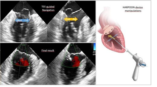 TEE navigation in orthogonal planes in a patient with P2 prolapse (left-upper panel) with a bright echo of the HARPOON device visible in the left ventricle. Anatomical drawing showing the device manipulations (right panel). Final result (left-lower panel) – bright echo of knots is visible. Good coaptation without mitral regurgitation is demonstrated in bi-plane colour Doppler study.
